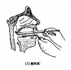 间接鼻咽镜(后鼻镜)检查法