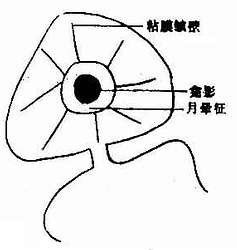 十二指肠球部溃疡(龛影)