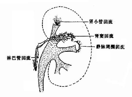 肾盂各种逆(回)流