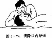 心肺复苏——清除口内异物