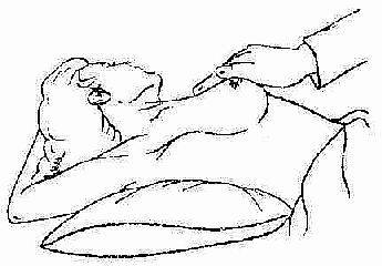 乳腺触诊 病人仰卧,上臂外展